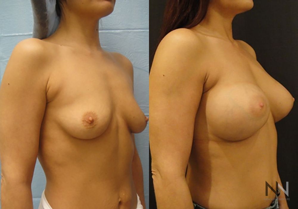 Breast Augmentation - Thumbnail 2