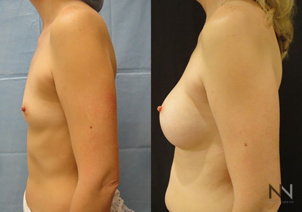 Breast Augmentation - Thumbnail 4