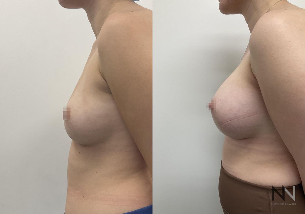 Breast Augmentation - Thumbnail 2