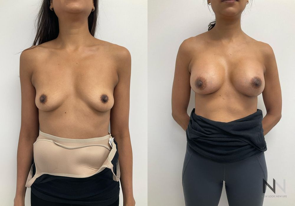 Breast Augmentation - Case 1827
