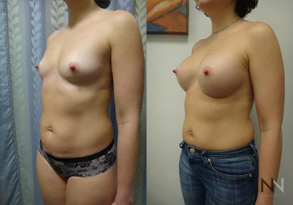 Breast Augmentation - Thumbnail 2
