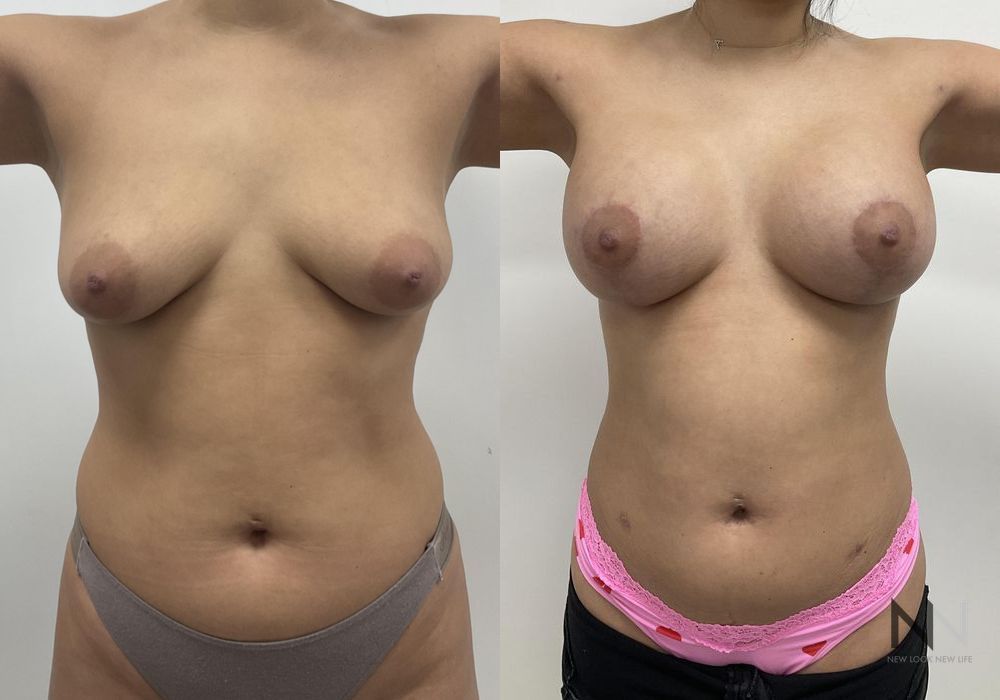 Breast Augmentation - Thumbnail 2