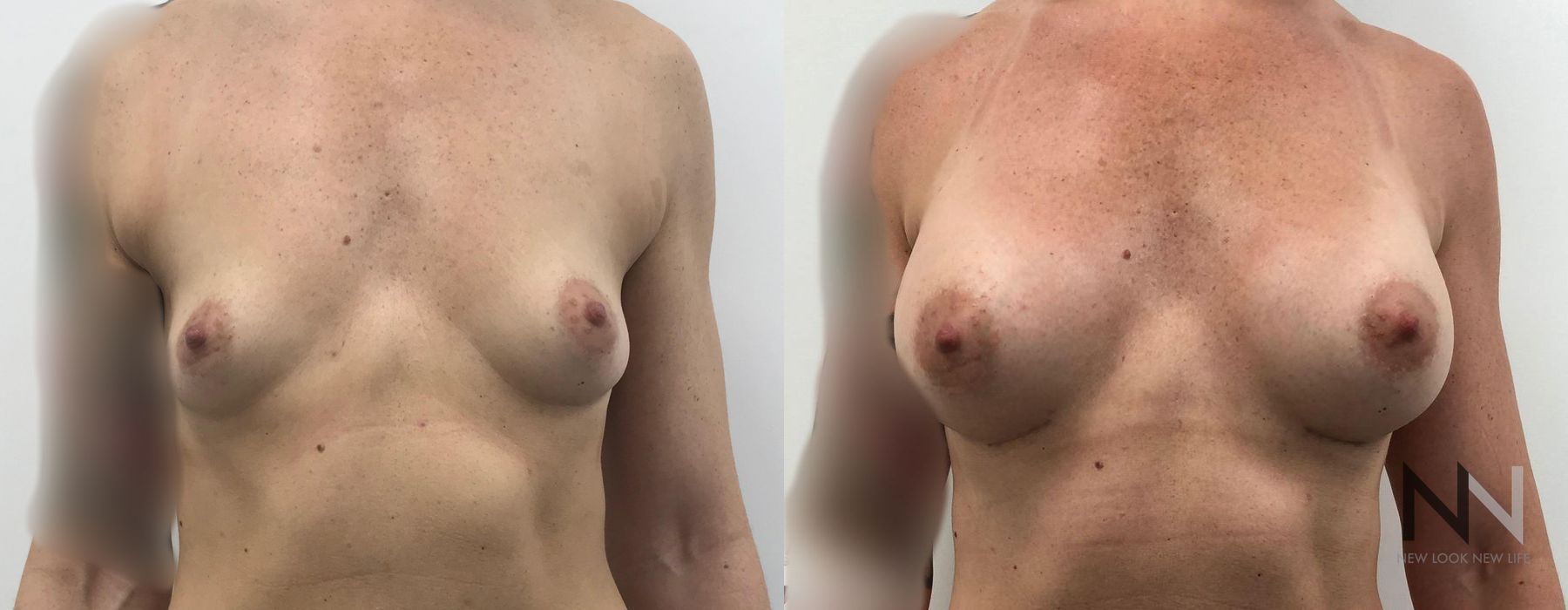 Breast Augmentation - Case 1990