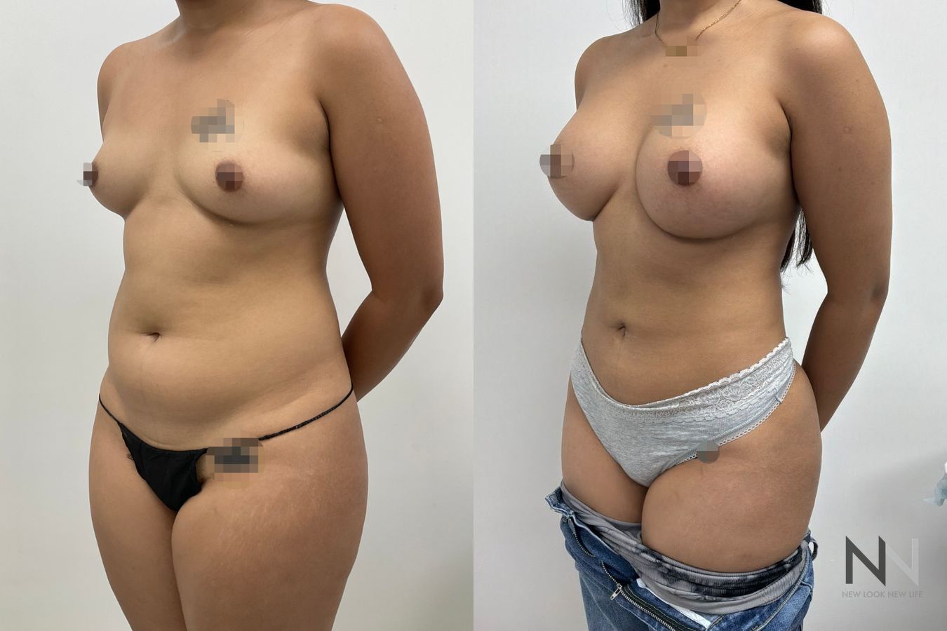 Before-and-after images of Liposuction 360 by Dr. Claudia Kim, showcasing contouring of the abdomen, flanks, back, and underarm areas for a more defined silhouette. - Angle 4
