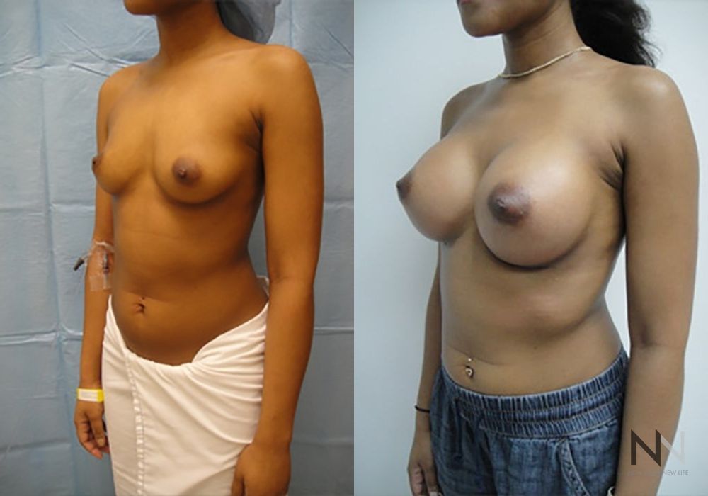 Breast Augmentation - Thumbnail 2