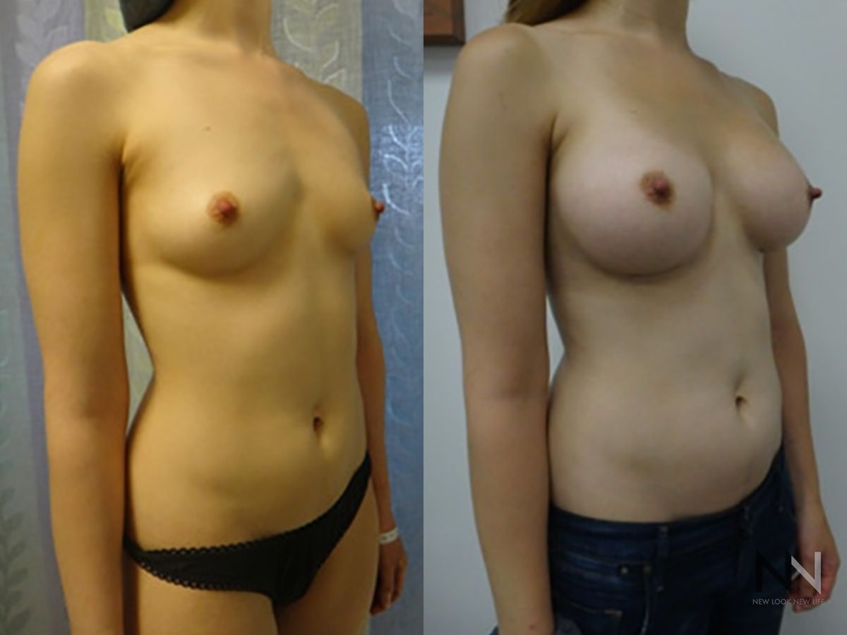 Before and after breast augmentation six months results - Angle 3