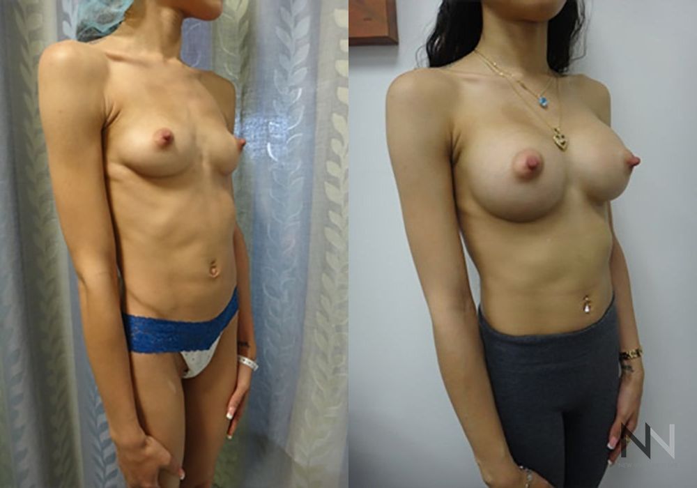 Breast Augmentation - Thumbnail 4