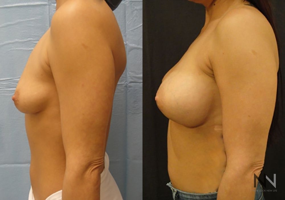 Breast Augmentation - Thumbnail 5