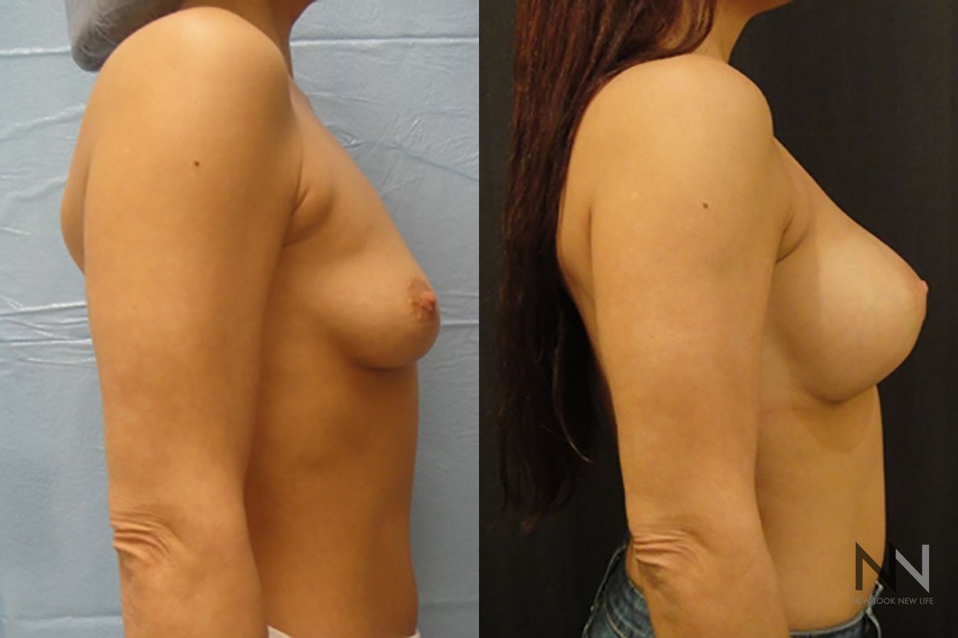 Breast augmentation before and after symmetry improvement - Angle 5