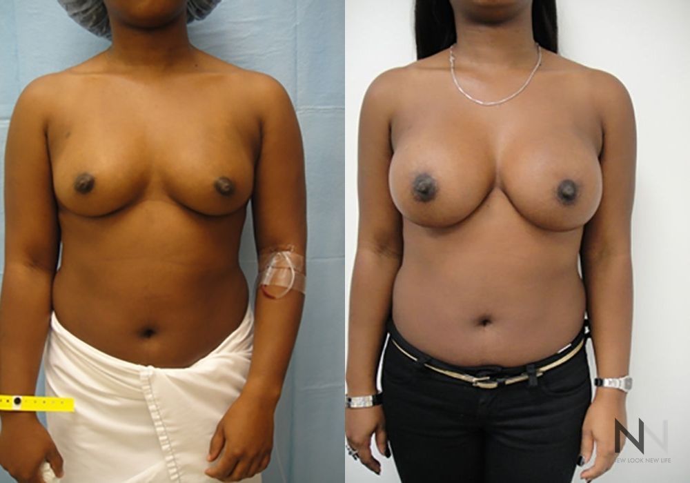 Breast Augmentation - Thumbnail 2