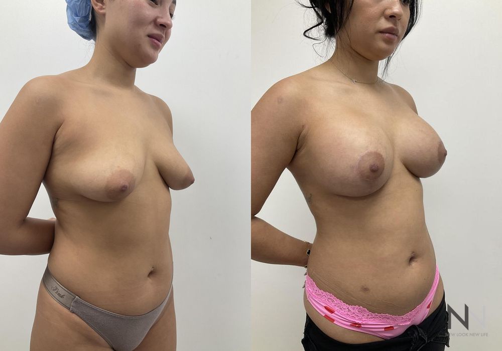 Breast Augmentation - Thumbnail 5