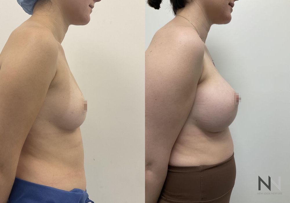 Breast Augmentation - Thumbnail 3