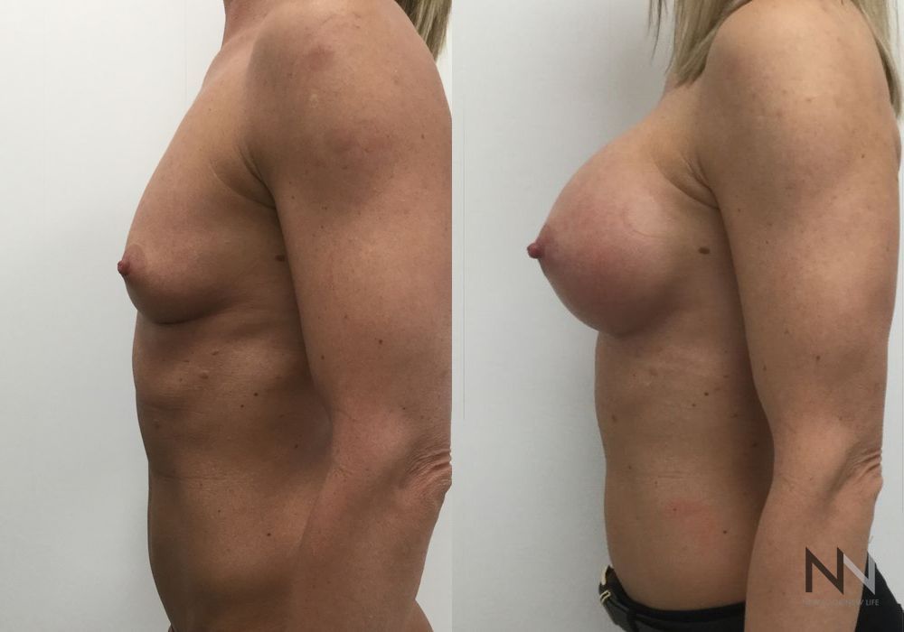Breast Augmentation - Thumbnail 3
