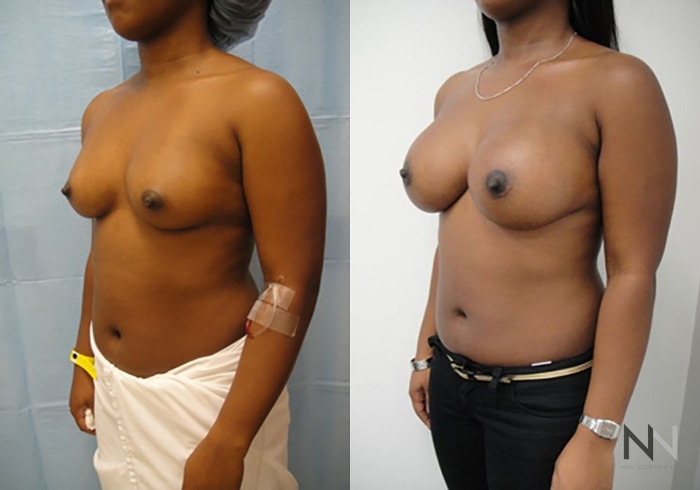 Breast Augmentation - Thumbnail 3