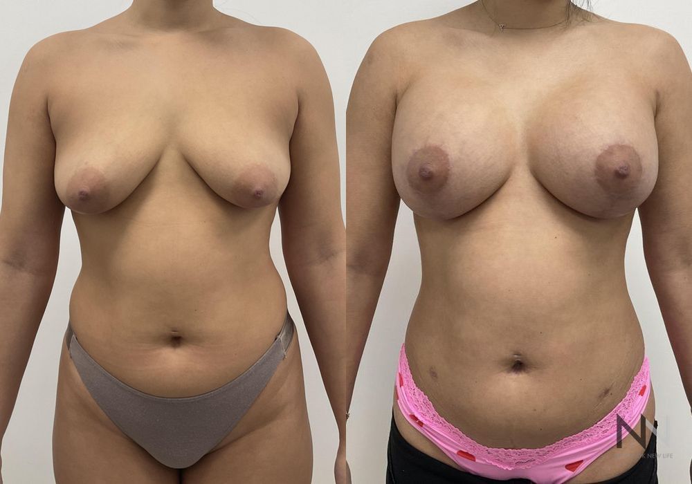 Breast Augmentation - Thumbnail 4