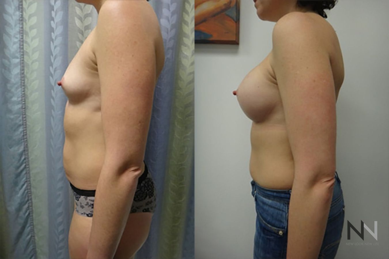 Breast augmentation before and after symmetry improvement - Angle 3