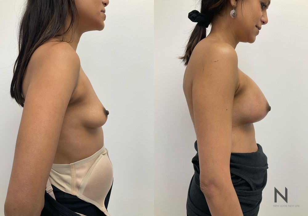 Breast Augmentation - Thumbnail 3