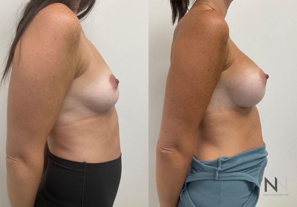 Breast Augmentation - Thumbnail 2