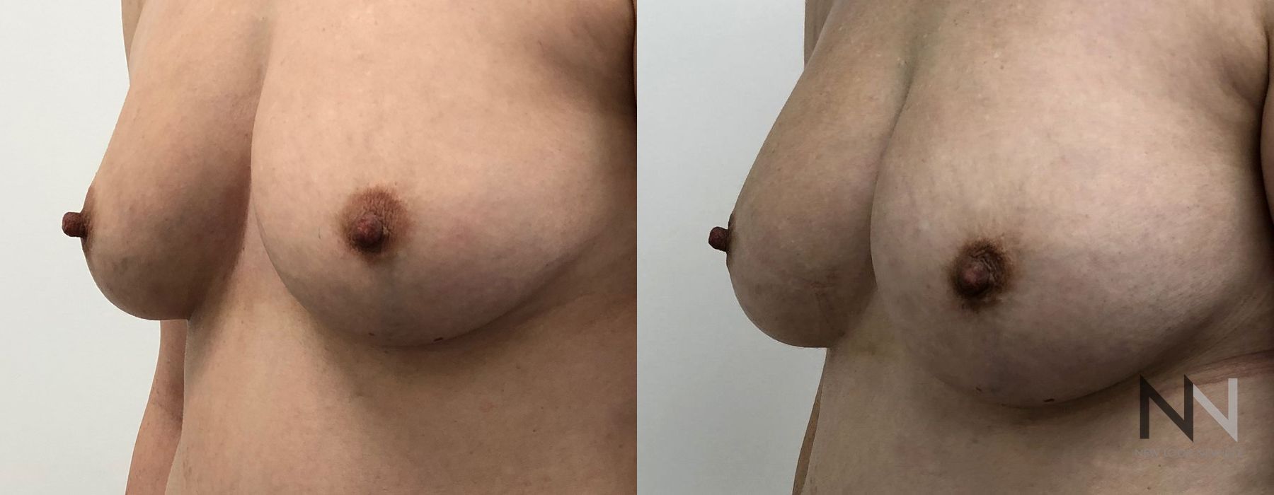 Breast Augmentation - Thumbnail 4