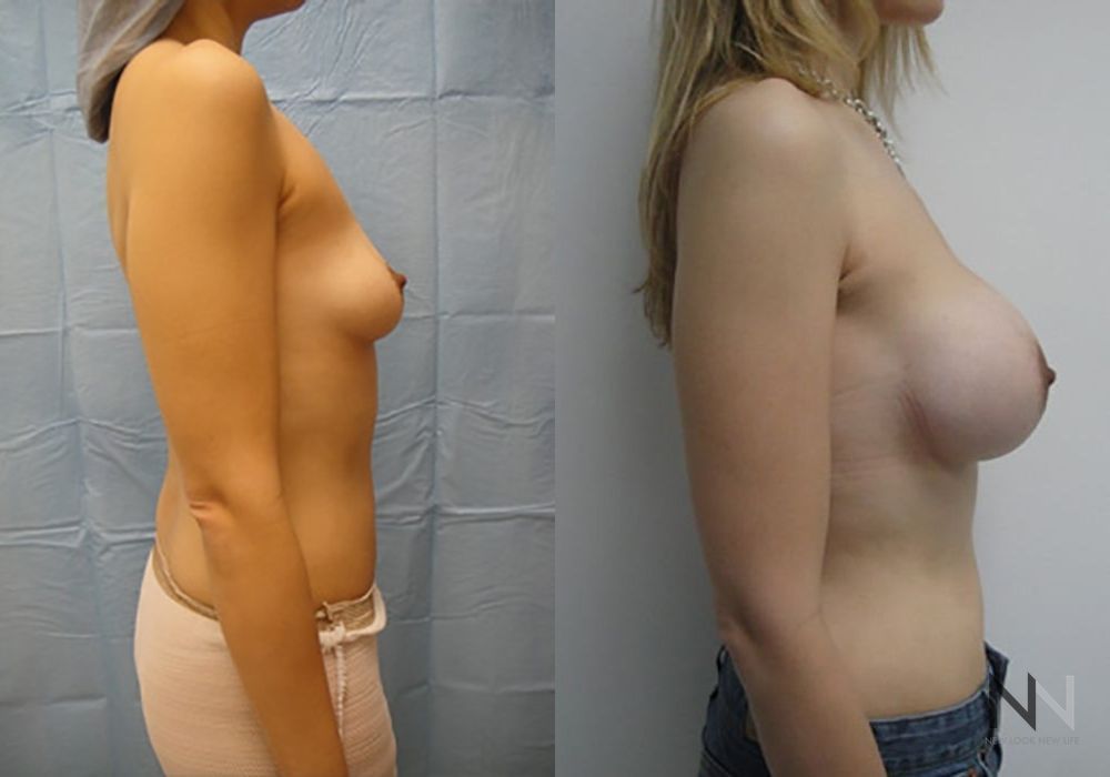 Breast Augmentation - Thumbnail 4