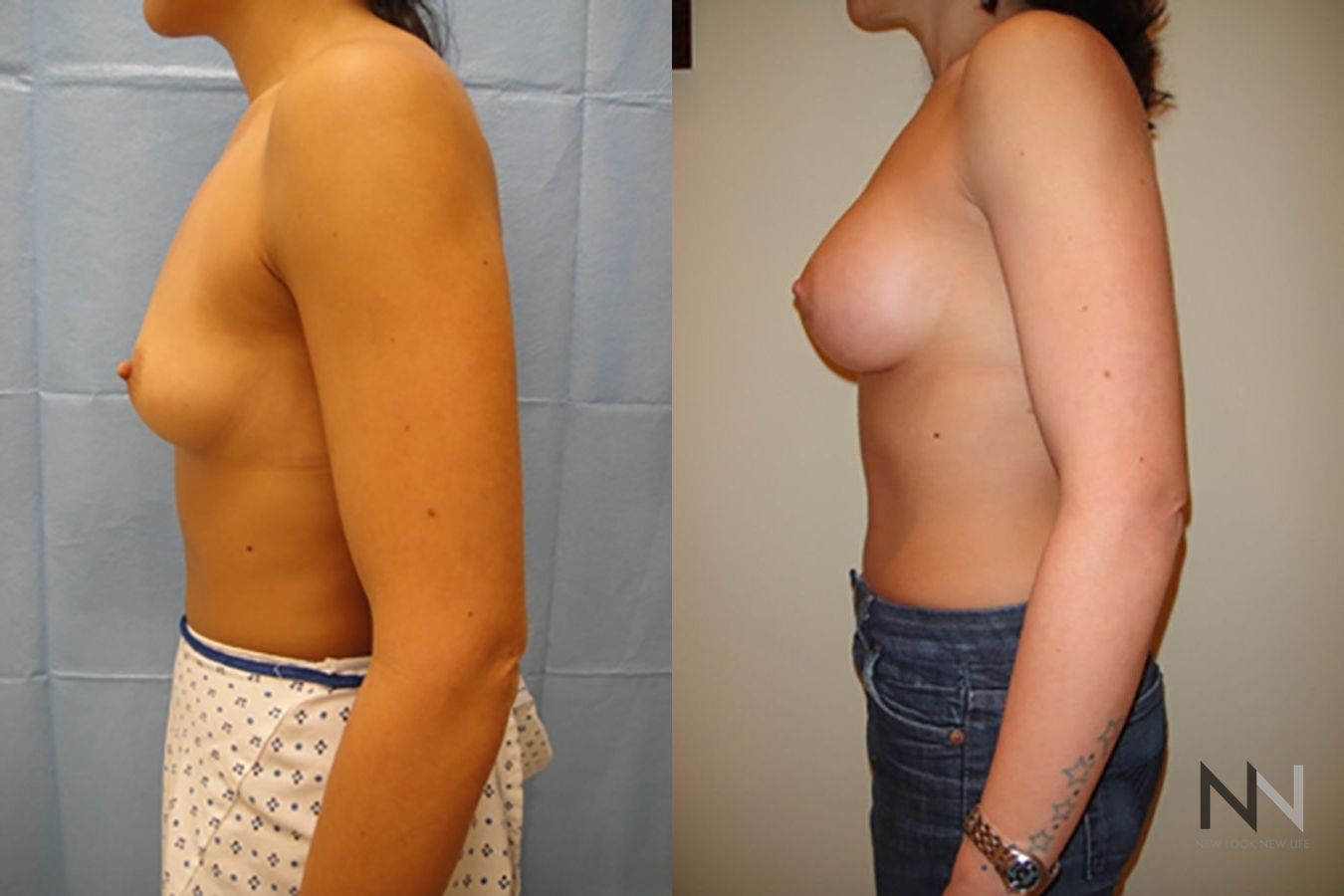 Breast contour enhancement six months post-op - Angle 3
