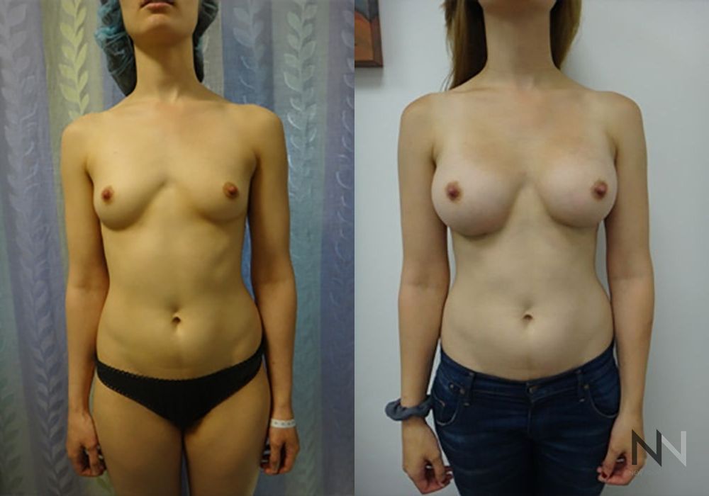 Breast Augmentation - Case 1809