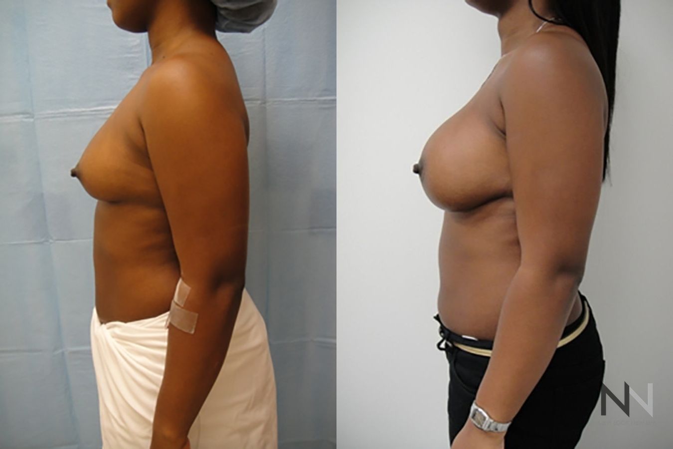 Before and after breast augmentation six months results - Angle 3