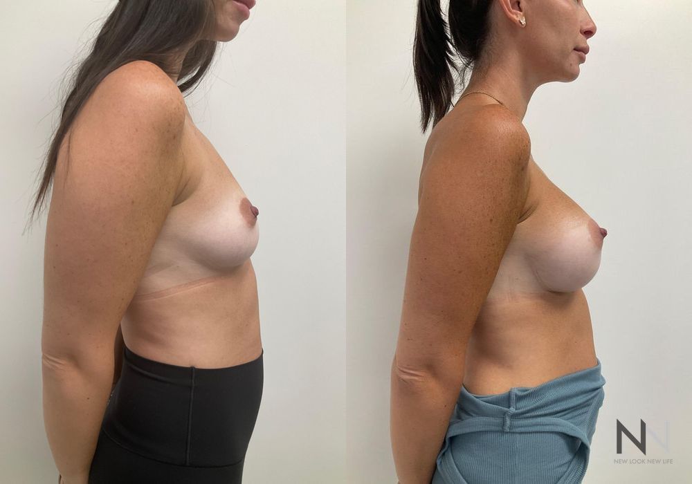 Breast Augmentation - Thumbnail 3