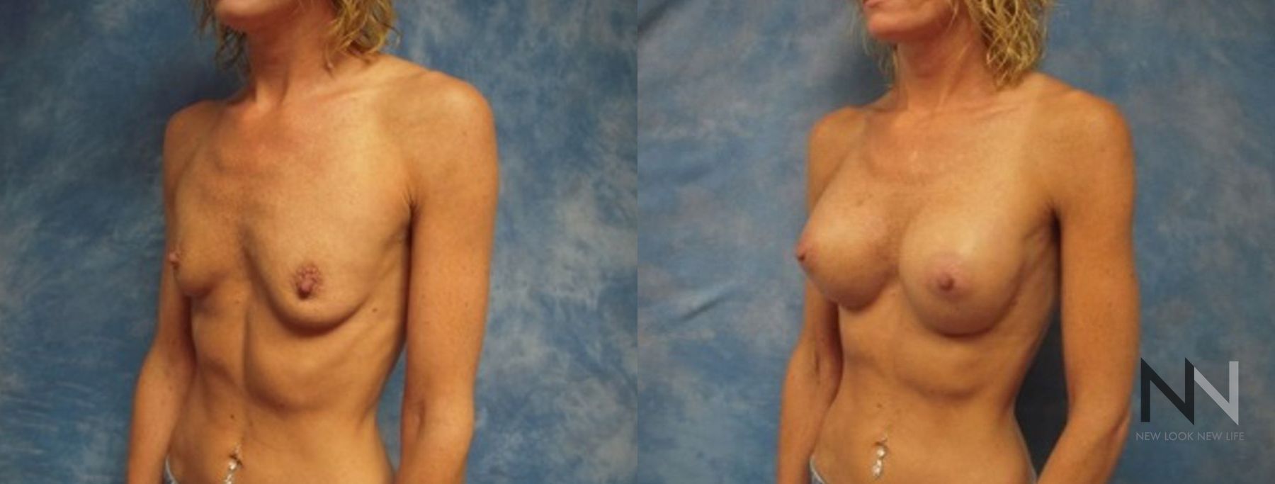 Breast augmentation before and after symmetry improvement - Angle 2