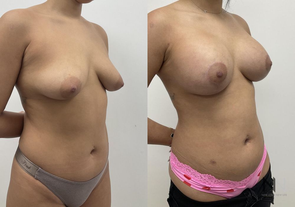 Breast Augmentation - Thumbnail 6