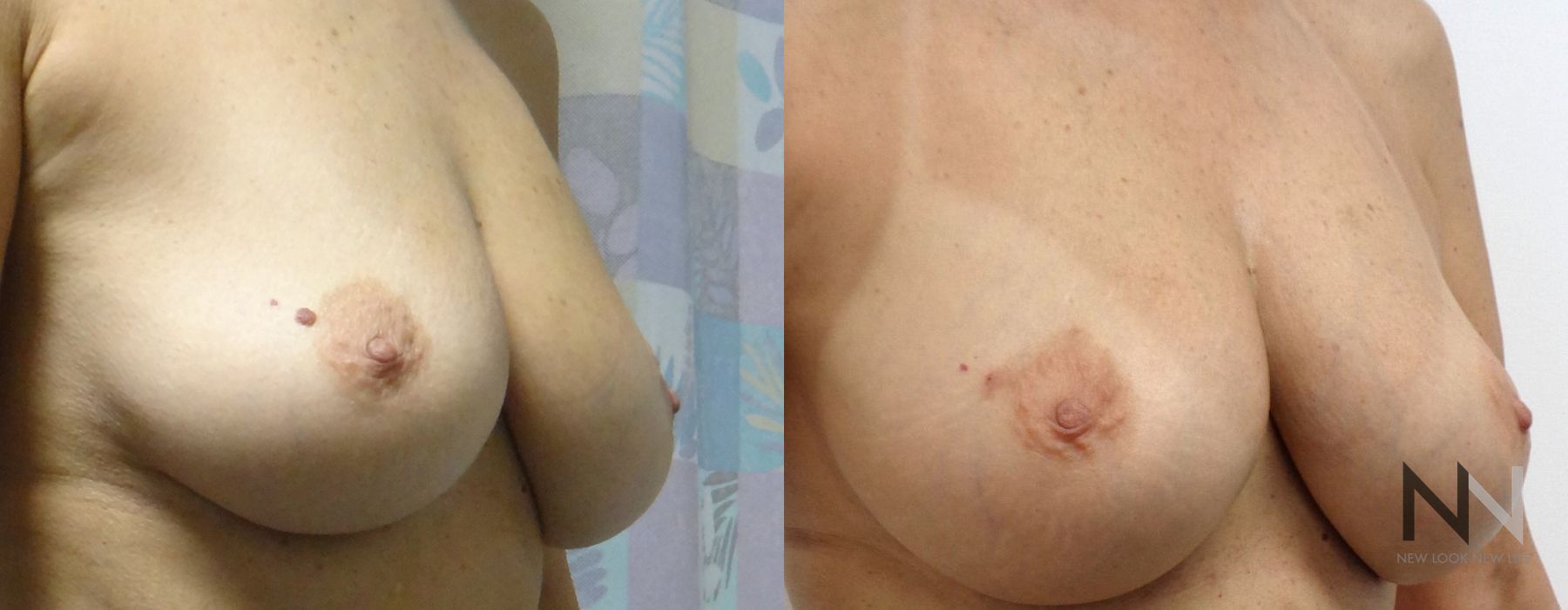 Breast Augmentation - Thumbnail 3