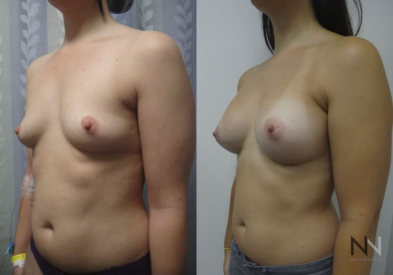 Breast augmentation before and after symmetry improvement - Angle 4