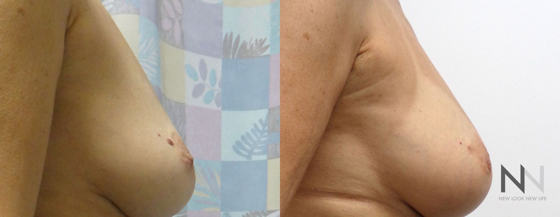 Breast Augmentation - Thumbnail 4