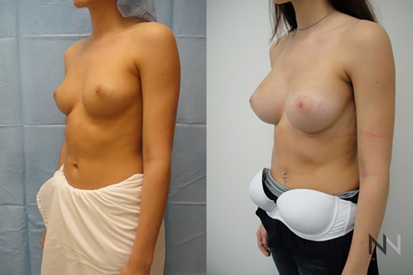 Before and after breast augmentation showing increased volume - Angle 2