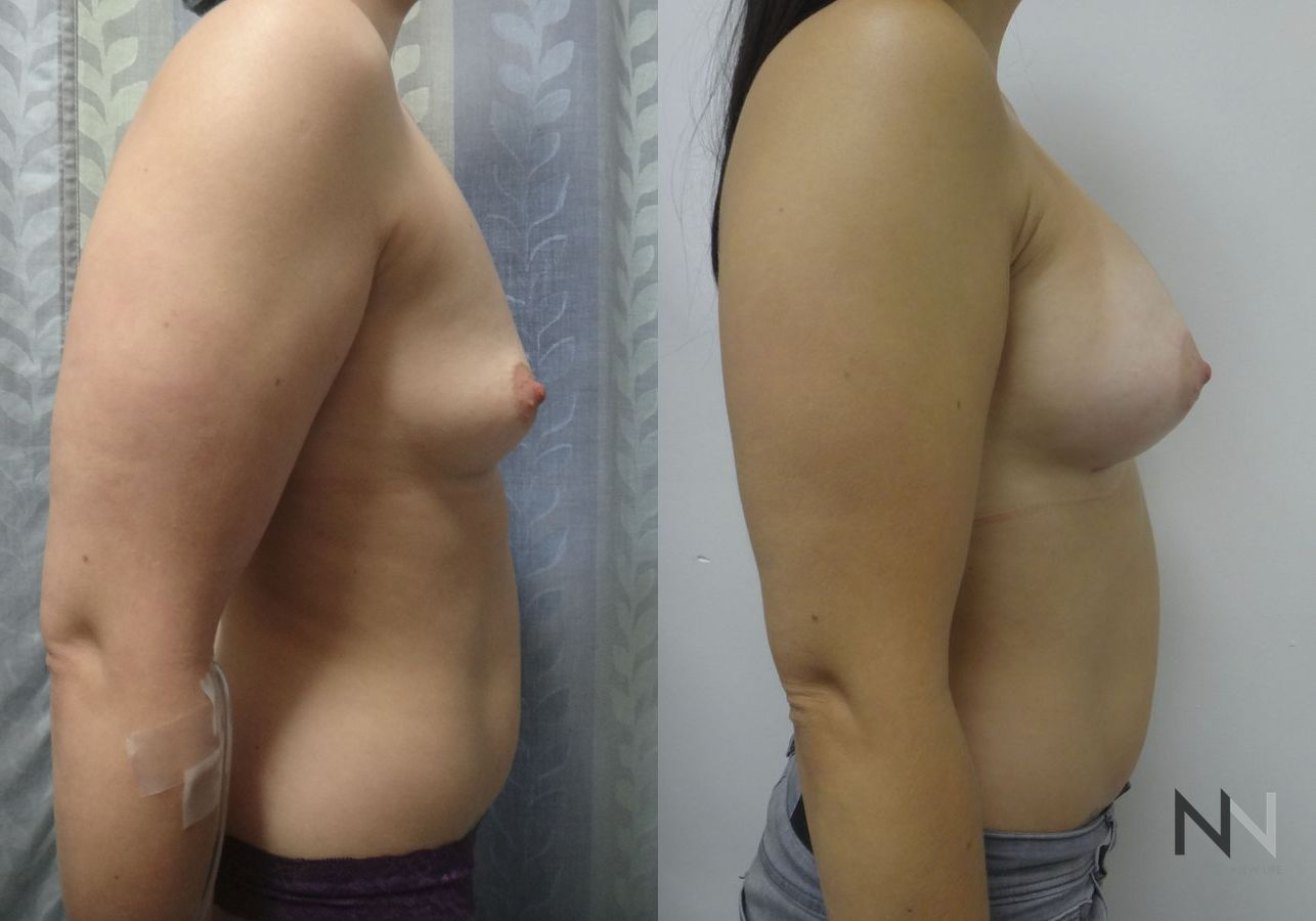 Breast augmentation before and after symmetry improvement - Angle 3