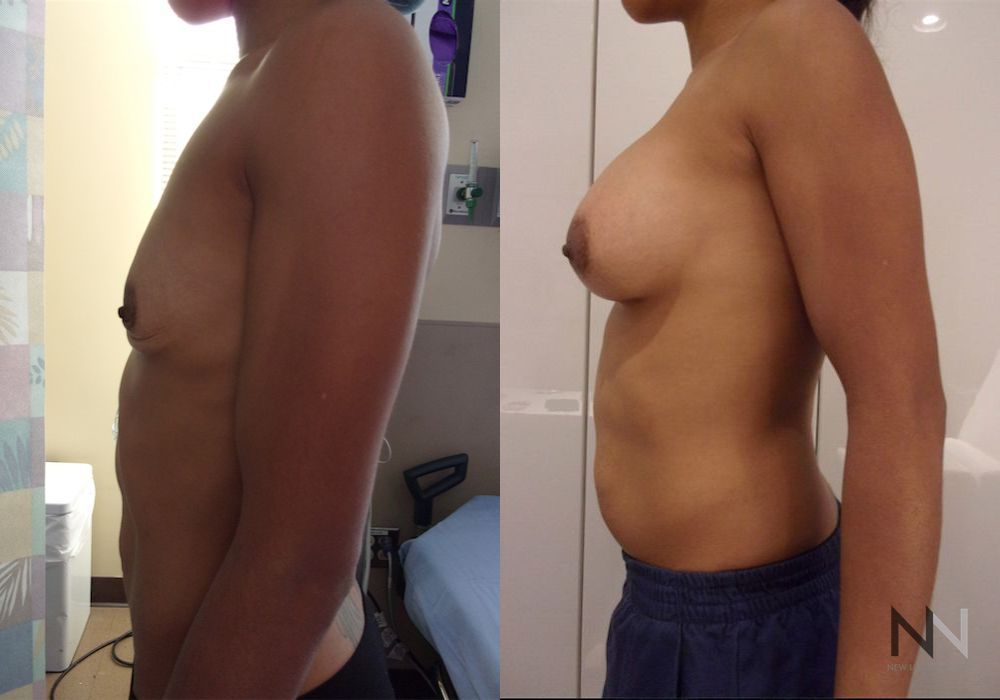 Breast Augmentation - Thumbnail 2