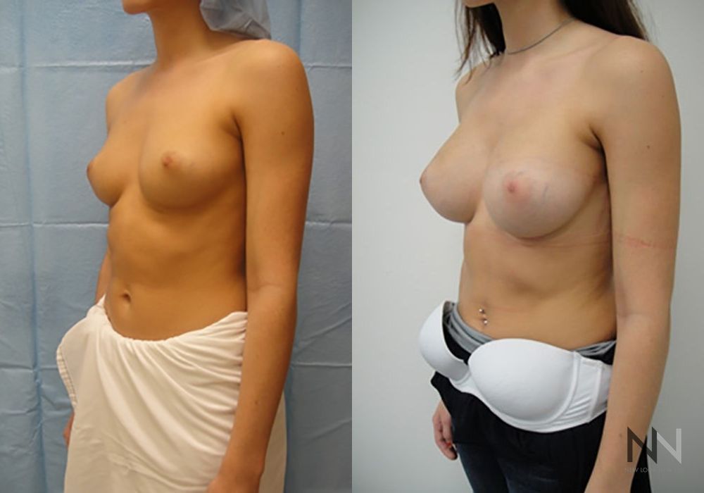 Breast Augmentation - Thumbnail 3