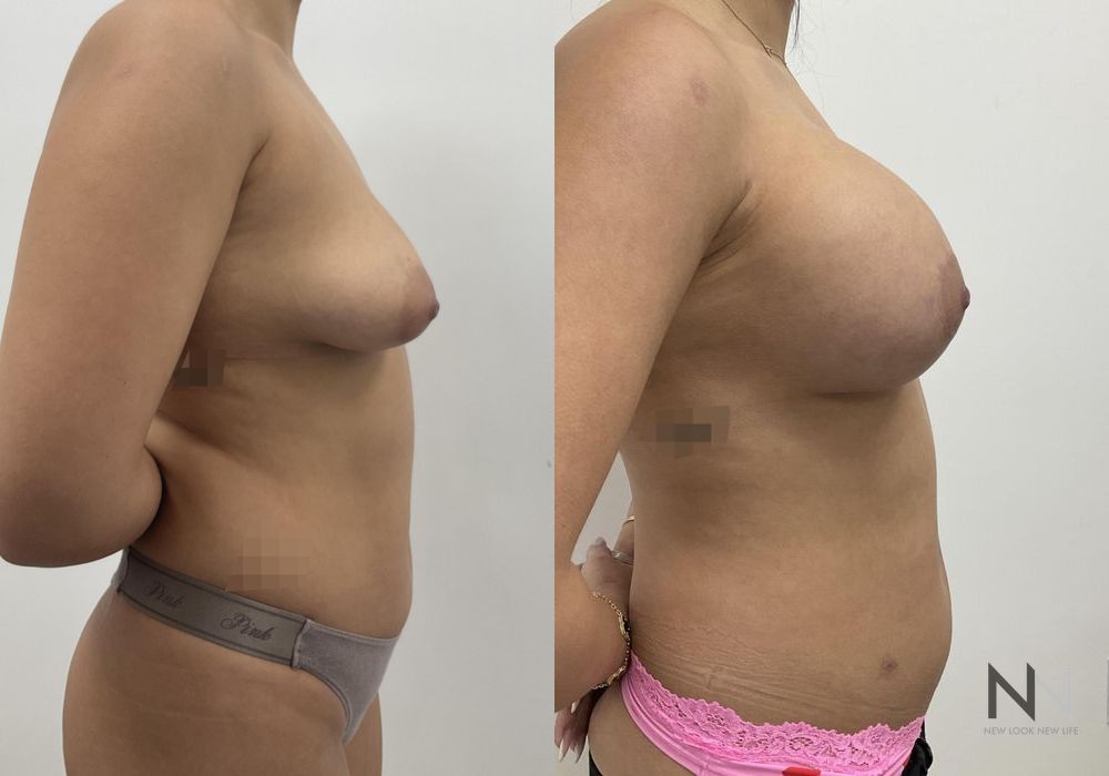 Breast Augmentation - Thumbnail 7