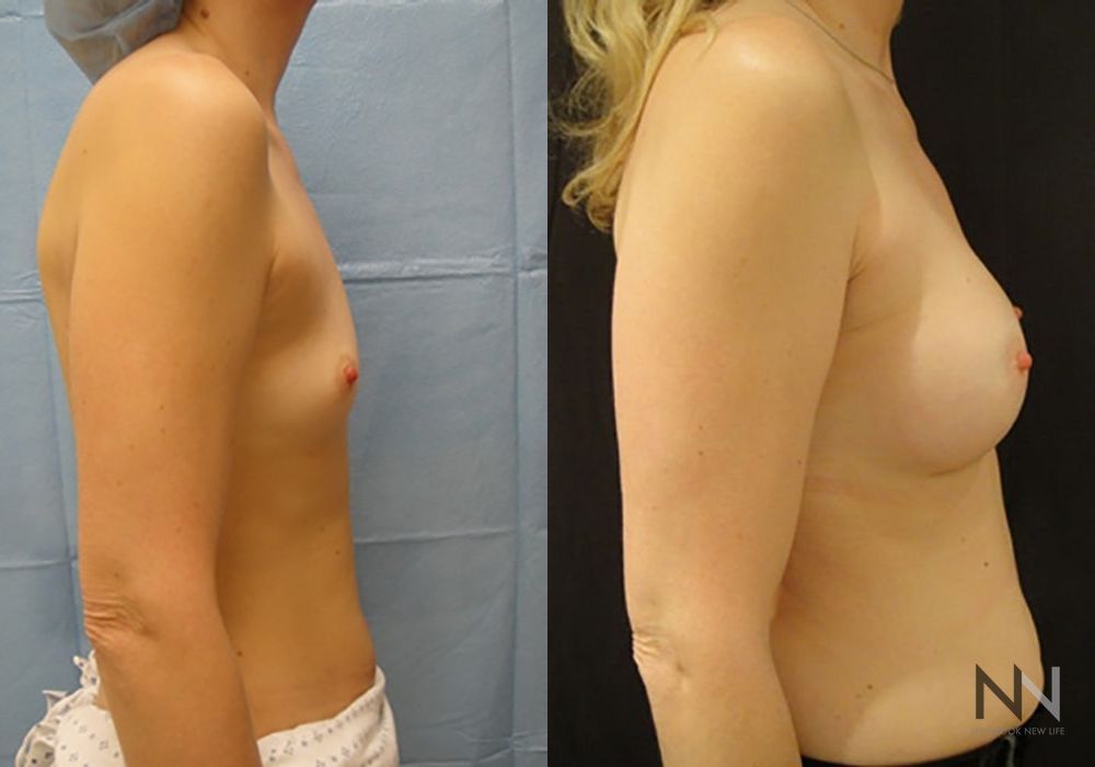 Breast Augmentation - Thumbnail 5
