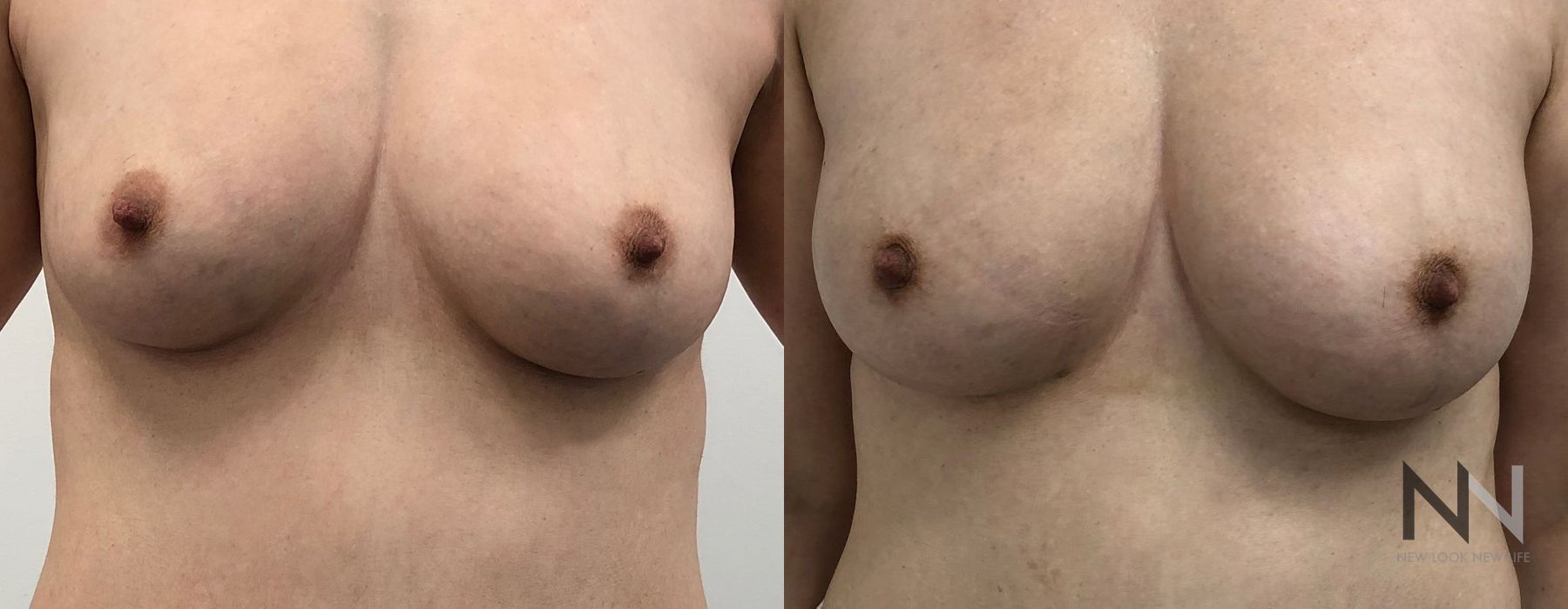 Breast Augmentation - Thumbnail 3