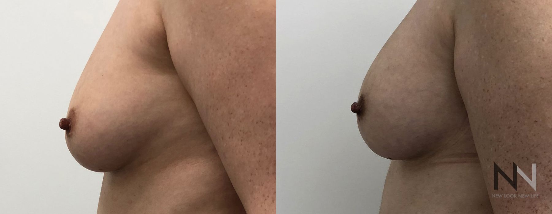 Breast Augmentation - Thumbnail 5