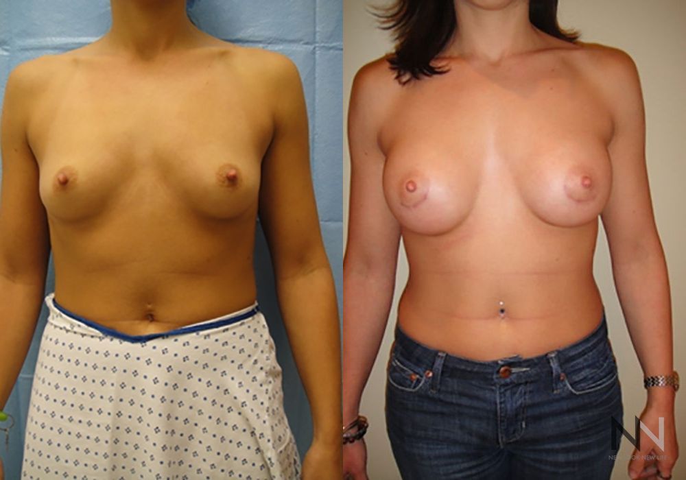 Breast Augmentation - Case 1813