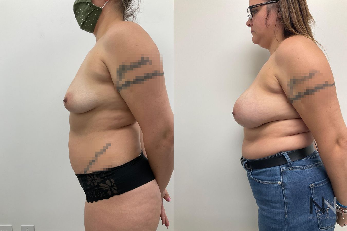 reast implants showing increased volume and projection - Angle 3