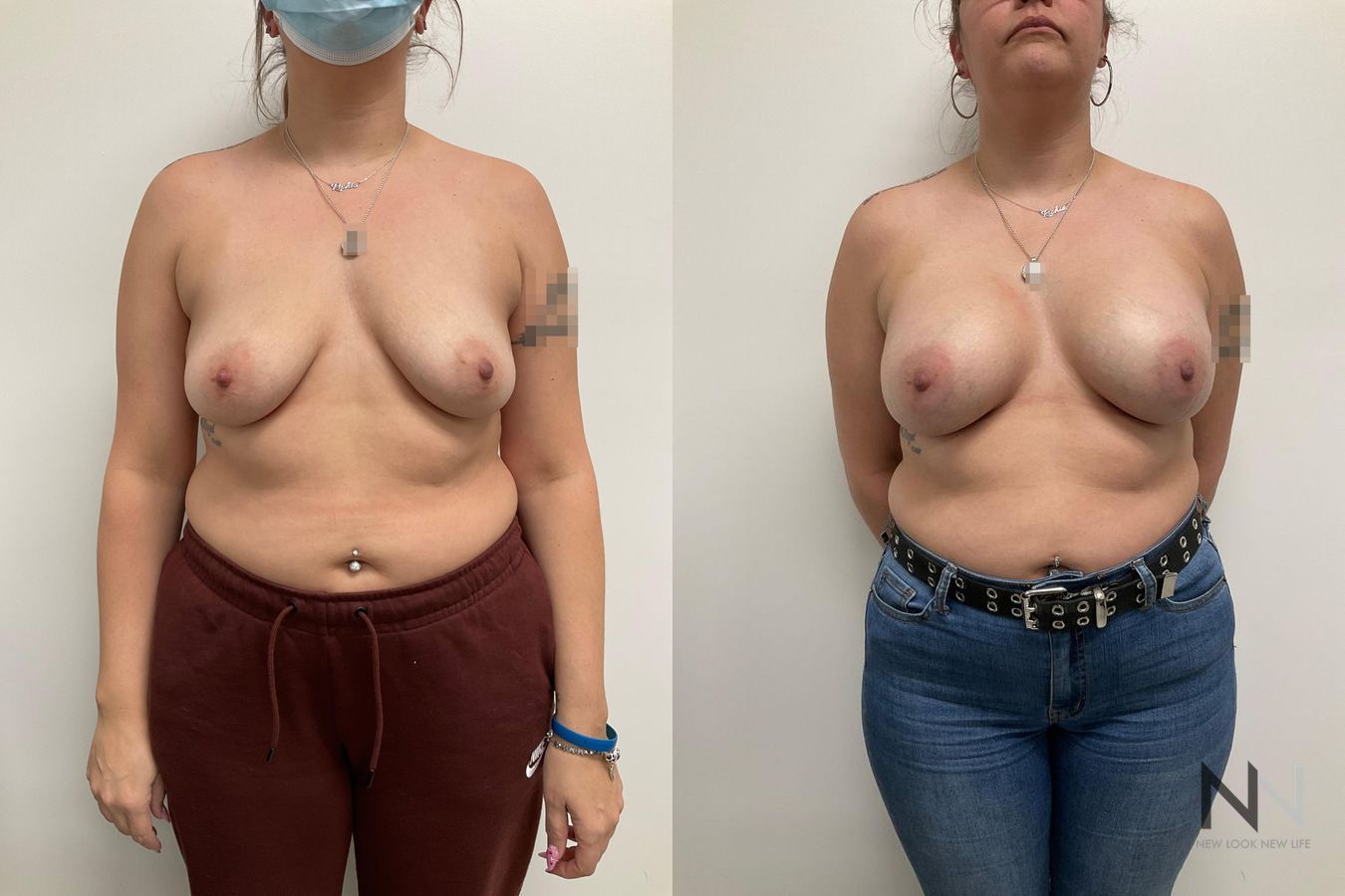 reast implants showing increased volume and projection