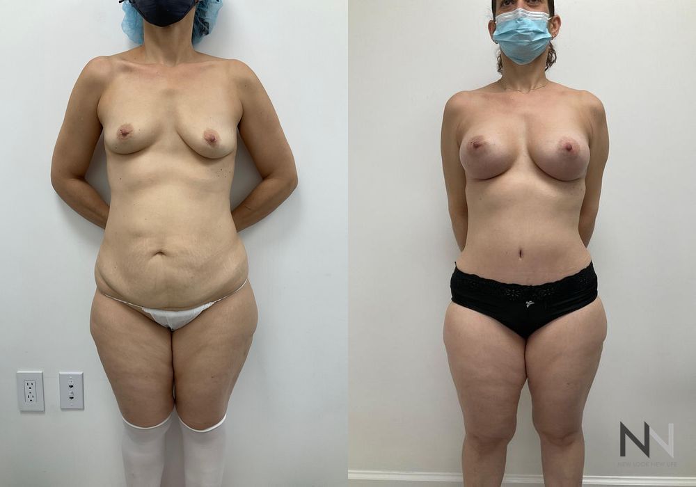 Breast Augmentation - Case 1823