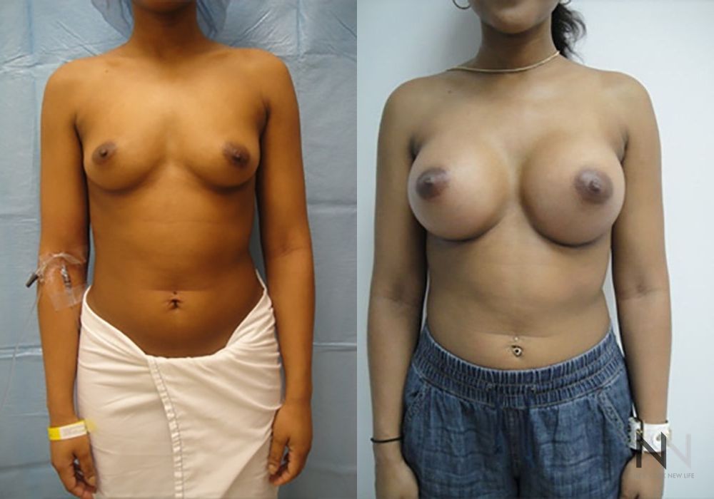 Breast Augmentation - Case 1816