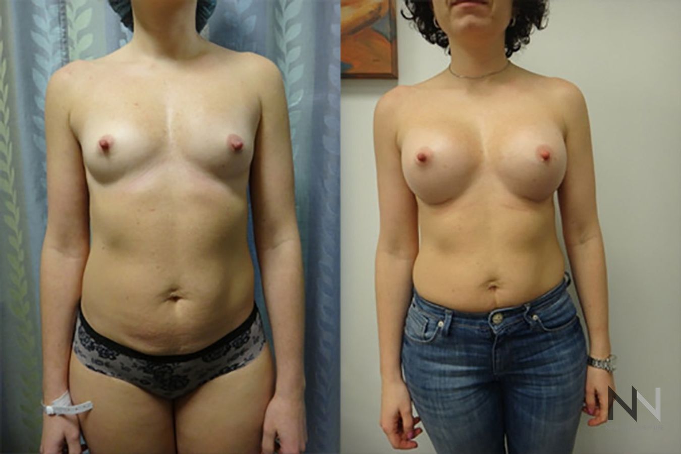 Breast augmentation before and after symmetry improvement