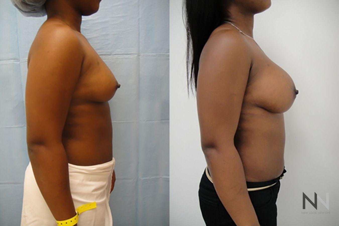 Before and after breast augmentation six months results - Angle 5