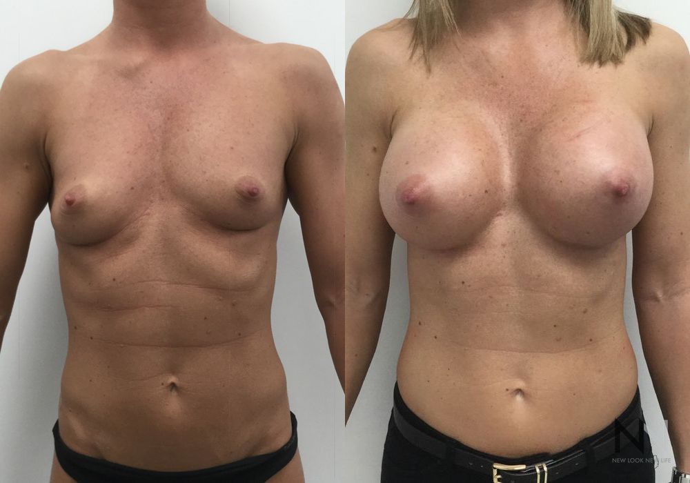 Breast Augmentation - Case 1805