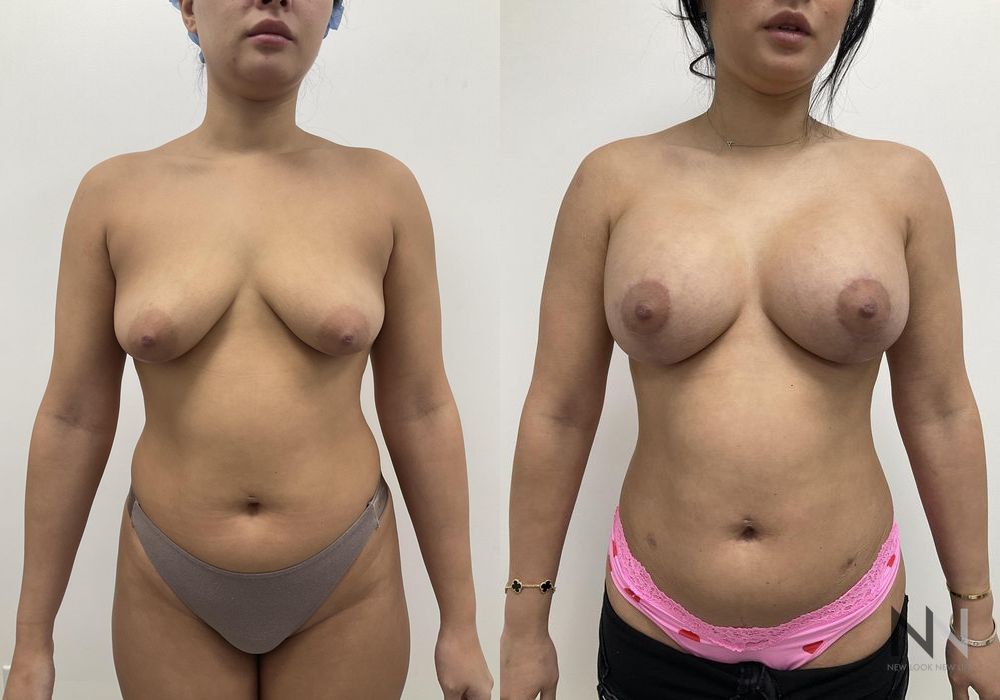 Breast Augmentation - Thumbnail 4